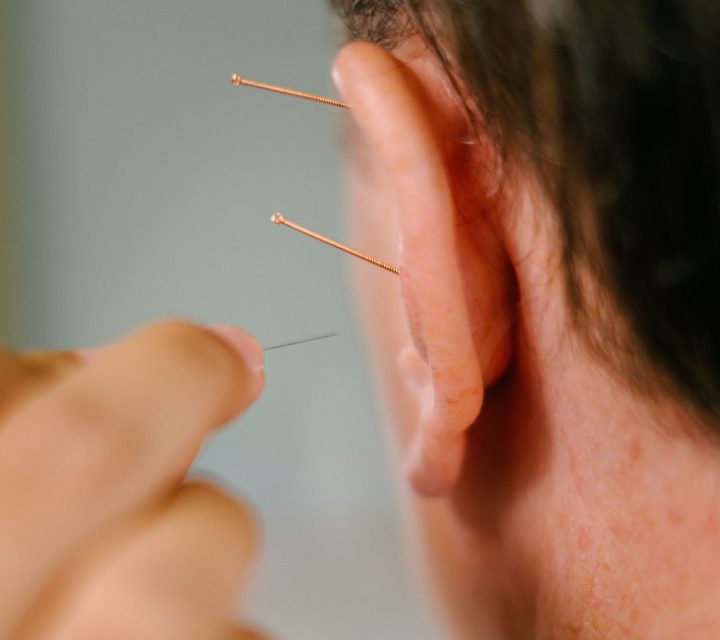 ear-acupuncture